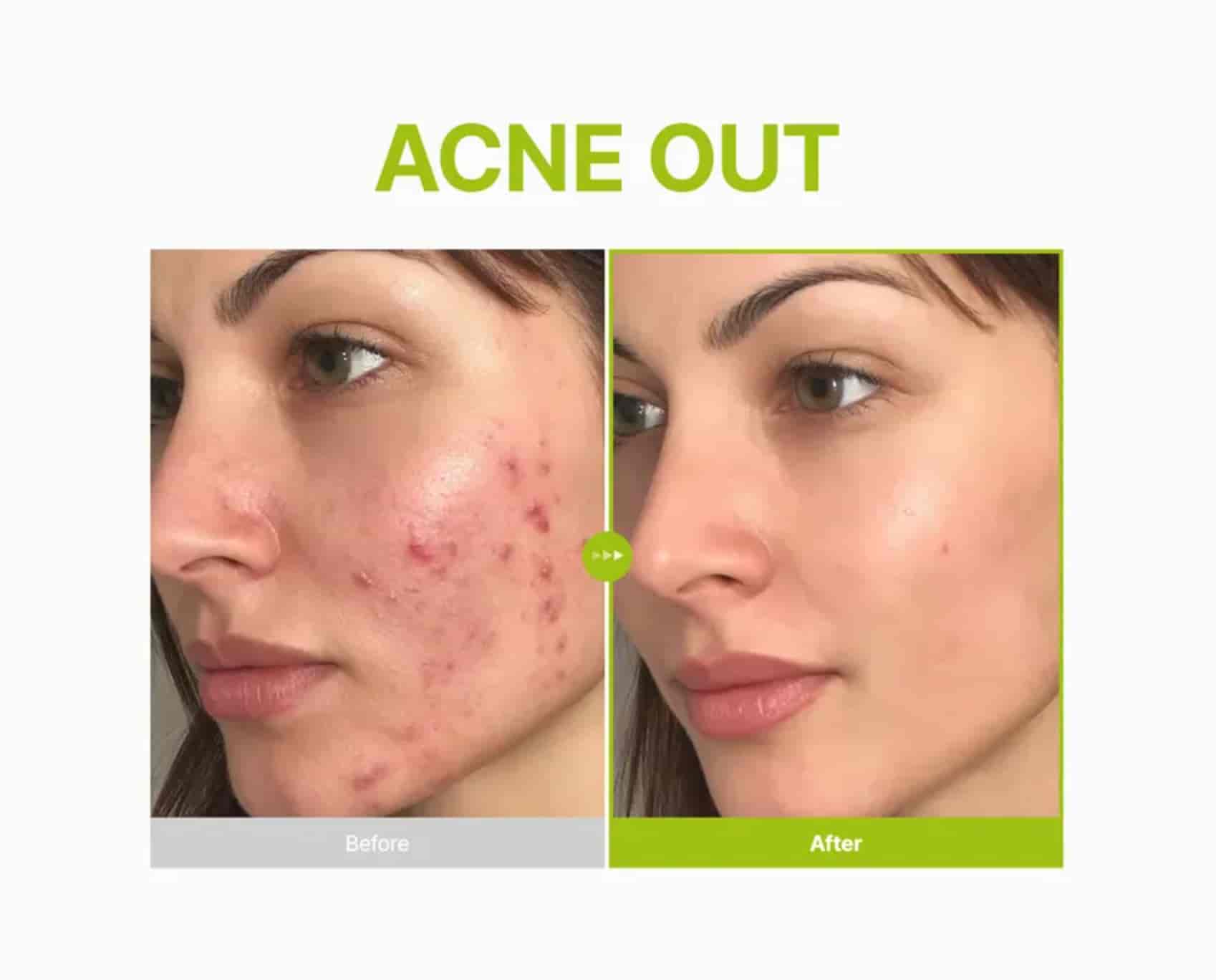 Purito SEOUL - Azelaic Acid 10 Kojic Tea Tree Serum 2