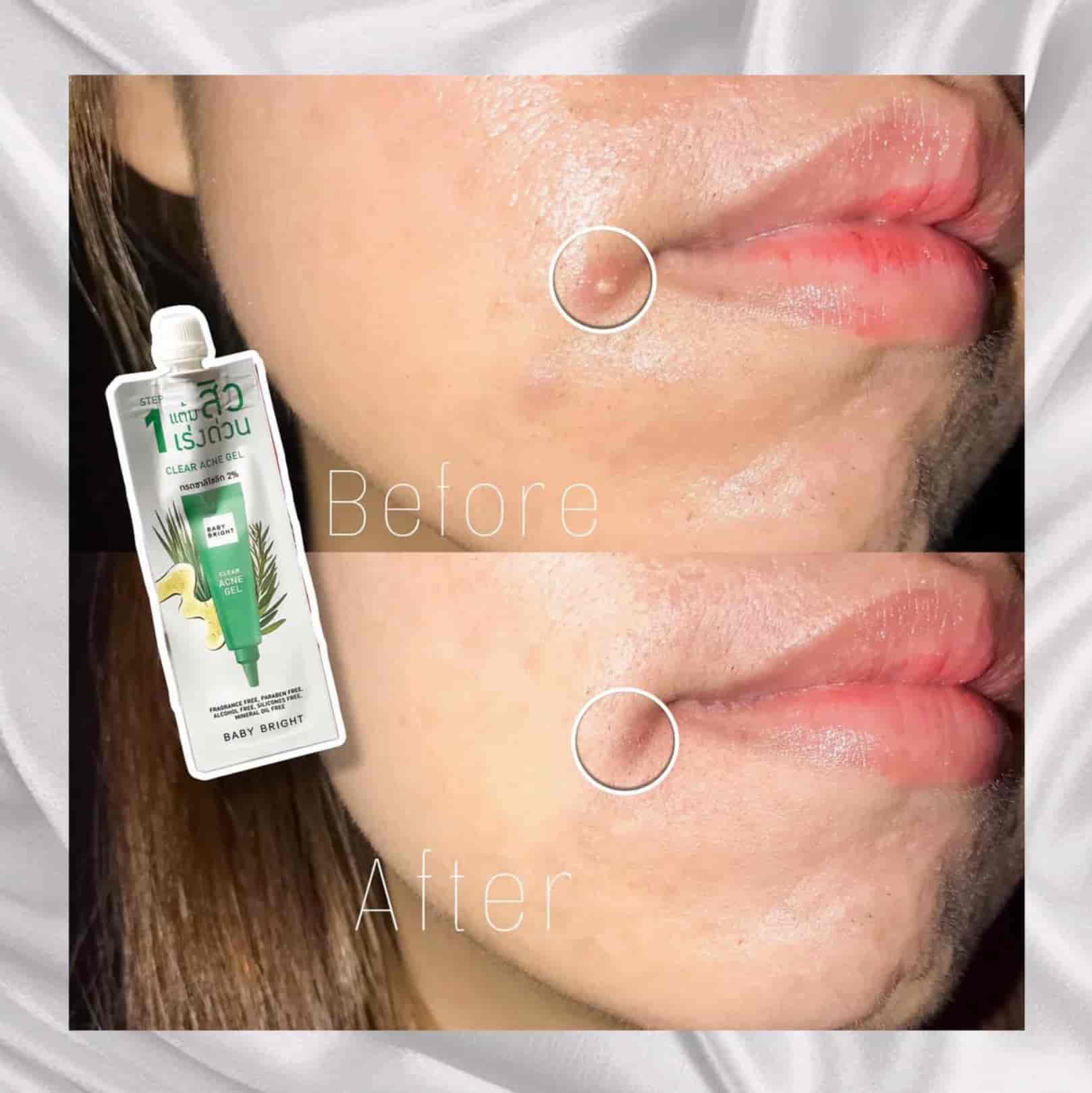 Baby Bright clear & treat acne set 3